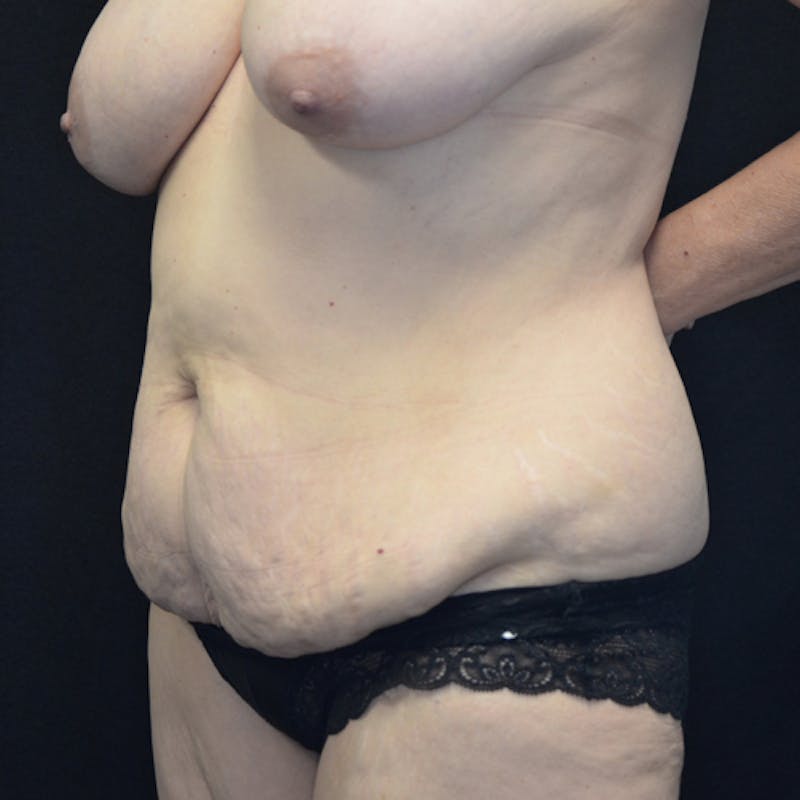 Abdominoplasty (Tummy Tuck) Before & After Gallery - Patient 114720955 - Image 7