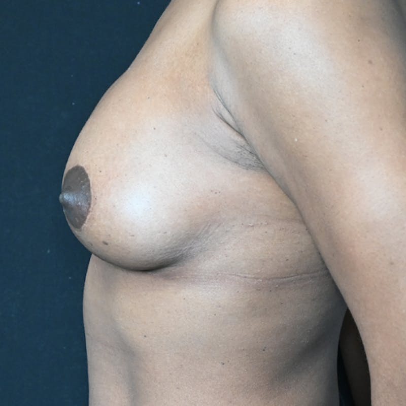 Breast Lift Before & After Gallery - Patient 118509270 - Image 4