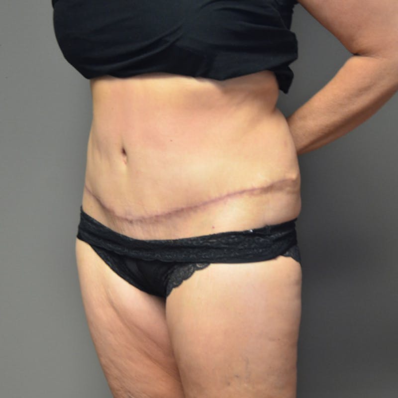 Abdominoplasty (Tummy Tuck) Before & After Gallery - Patient 114720955 - Image 8