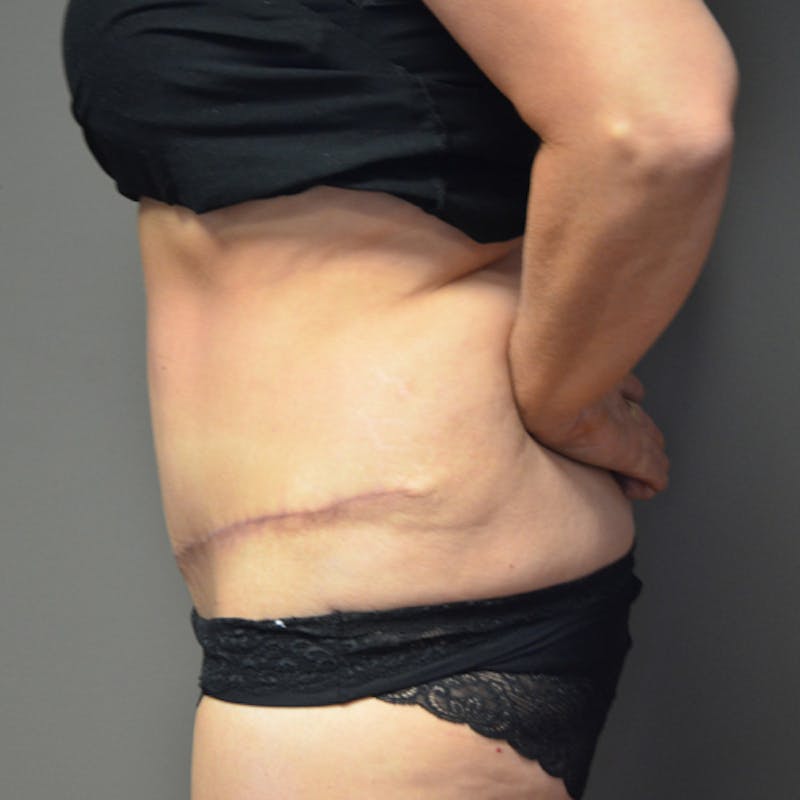Abdominoplasty (Tummy Tuck) Before & After Gallery - Patient 114720955 - Image 10