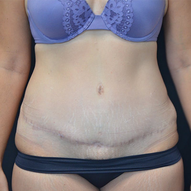Abdominoplasty (Tummy Tuck) Before & After Gallery - Patient 114720959 - Image 2