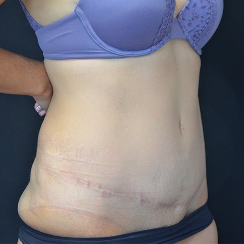 Abdominoplasty (Tummy Tuck) Before & After Gallery - Patient 114720959 - Image 4