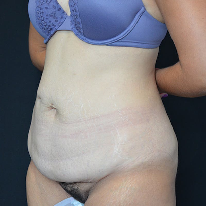 Abdominoplasty (Tummy Tuck) Before & After Gallery - Patient 114720959 - Image 5