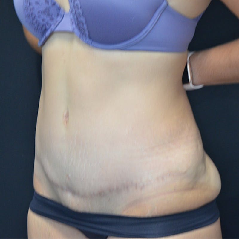 Abdominoplasty (Tummy Tuck) Before & After Gallery - Patient 114720959 - Image 6
