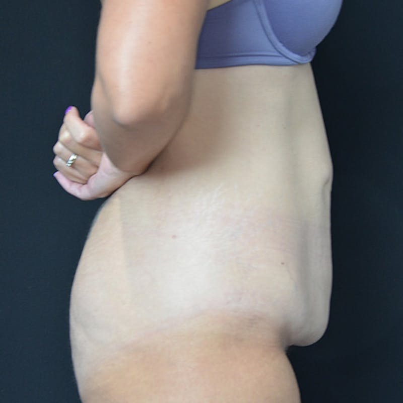Abdominoplasty (Tummy Tuck) Before & After Gallery - Patient 114720959 - Image 7