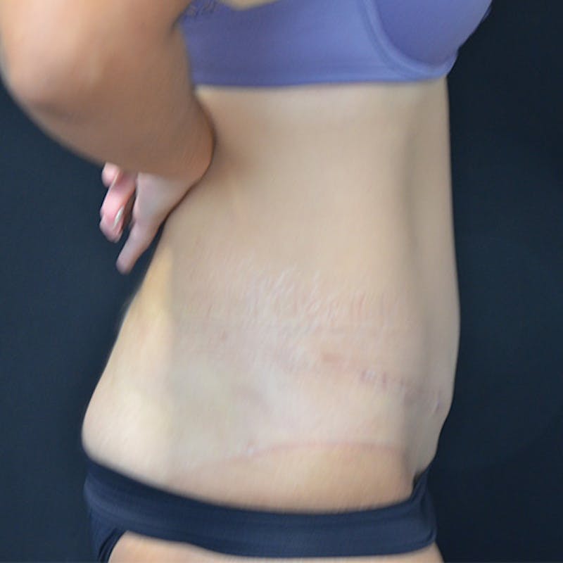Abdominoplasty (Tummy Tuck) Before & After Gallery - Patient 114720959 - Image 8