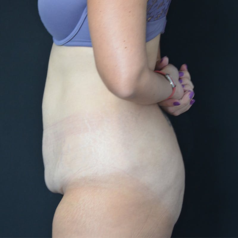 Abdominoplasty (Tummy Tuck) Before & After Gallery - Patient 114720959 - Image 9