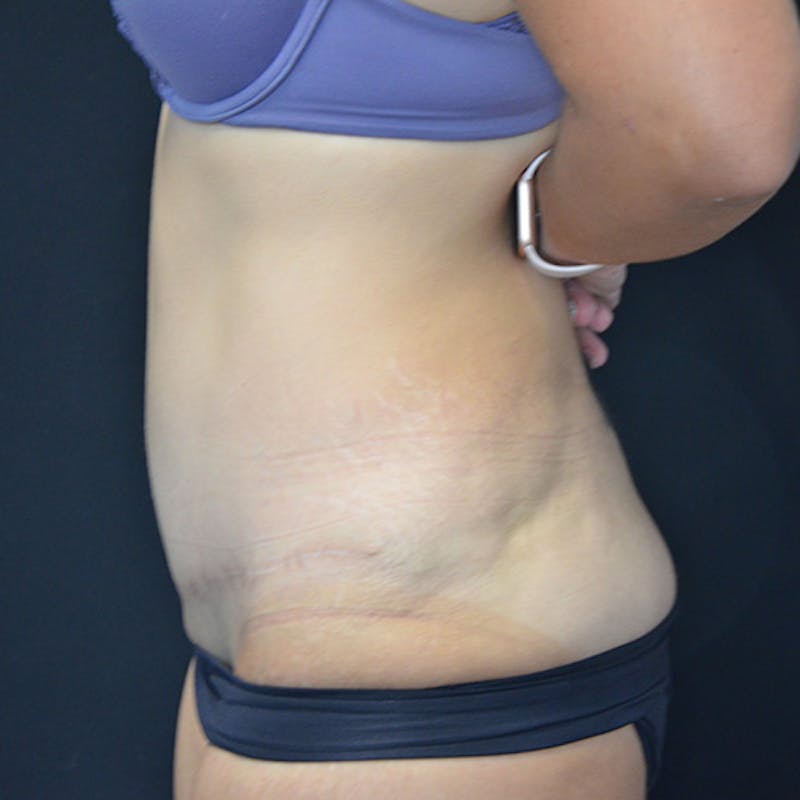 Abdominoplasty (Tummy Tuck) Before & After Gallery - Patient 114720959 - Image 10