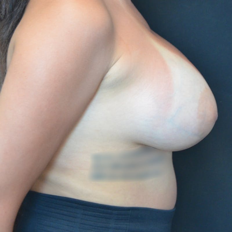 Breast Augmentation Before & After Gallery - Patient 114720960 - Image 4
