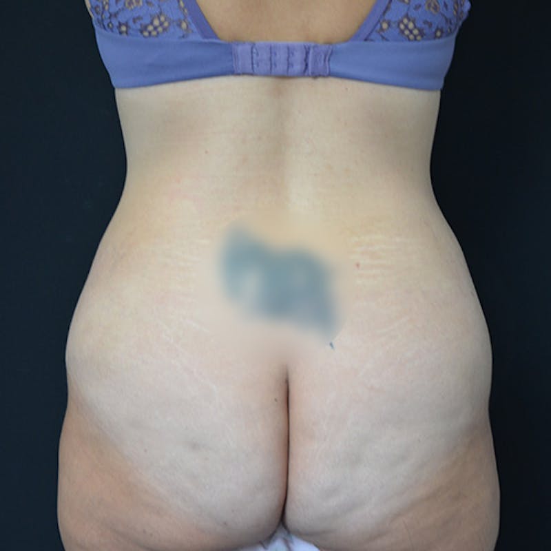 Abdominoplasty (Tummy Tuck) Before & After Gallery - Patient 114720959 - Image 11