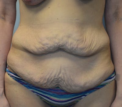 Abdominoplasty (Tummy Tuck) Before & After Gallery - Patient 114720961 - Image 1