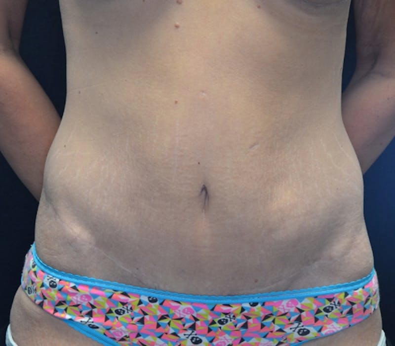 Abdominoplasty (Tummy Tuck) Before & After Gallery - Patient 114720961 - Image 2