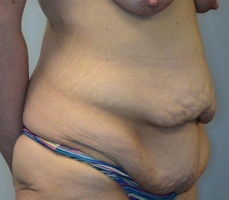 Abdominoplasty (Tummy Tuck) Before & After Gallery - Patient 114720961 - Image 3