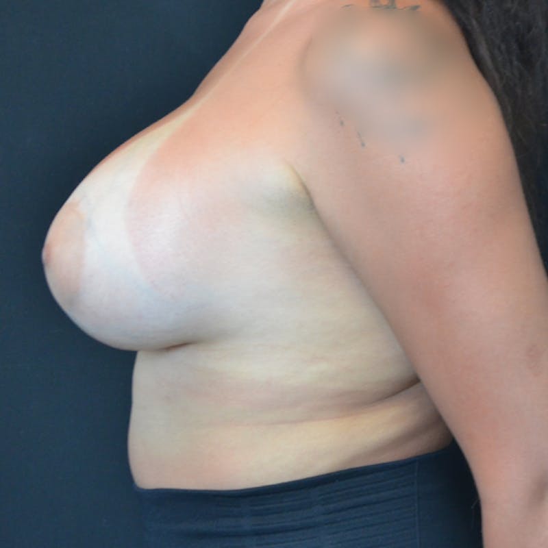 Breast Augmentation Before & After Gallery - Patient 114720960 - Image 8