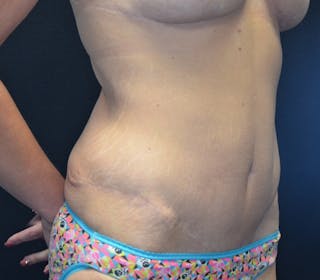 Abdominoplasty (Tummy Tuck) Before & After Gallery - Patient 114720961 - Image 4