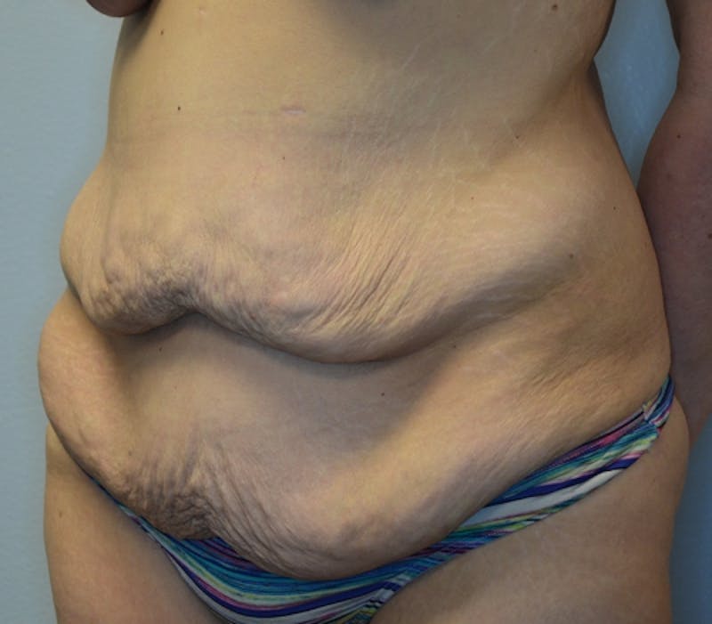 Abdominoplasty (Tummy Tuck) Before & After Gallery - Patient 114720961 - Image 5