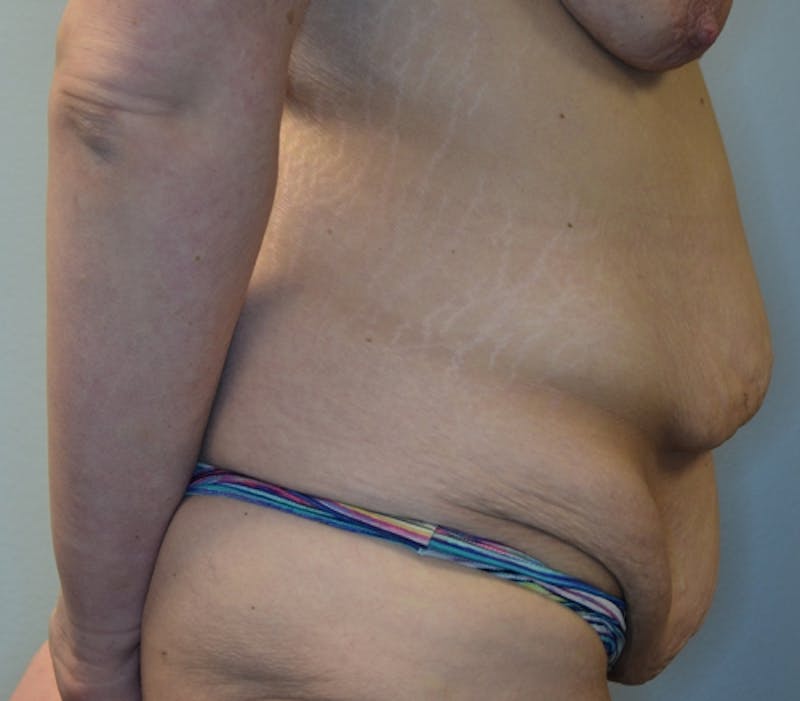 Abdominoplasty (Tummy Tuck) Before & After Gallery - Patient 114720961 - Image 7