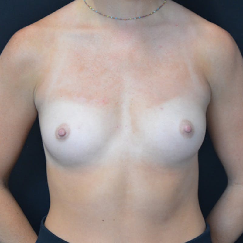 Breast Augmentation Before & After Gallery - Patient 114720976 - Image 1