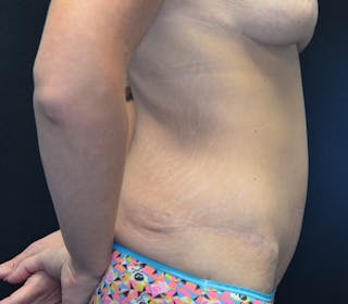 Abdominoplasty (Tummy Tuck) Before & After Gallery - Patient 114720961 - Image 8