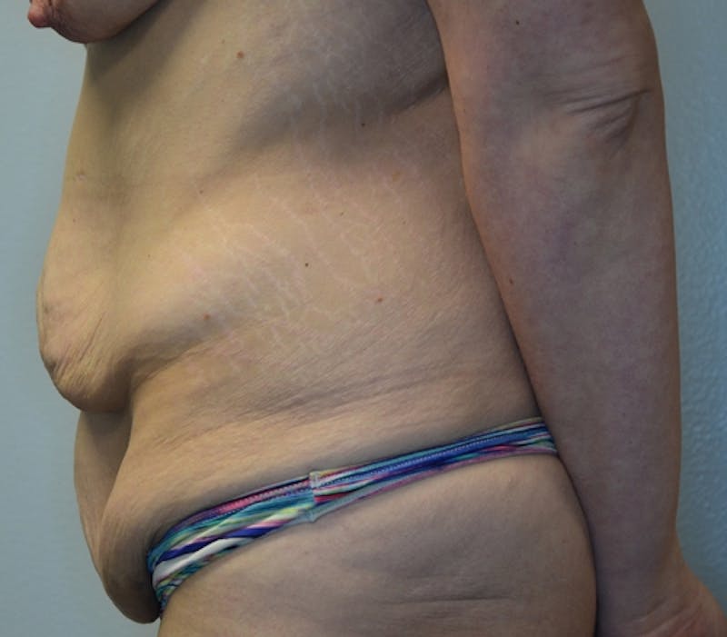 Abdominoplasty (Tummy Tuck) Before & After Gallery - Patient 114720961 - Image 9
