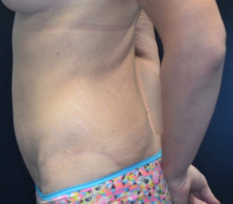 Abdominoplasty (Tummy Tuck) Before & After Gallery - Patient 114720961 - Image 10