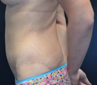 Abdominoplasty (Tummy Tuck) Before & After Gallery - Patient 114720961 - Image 10