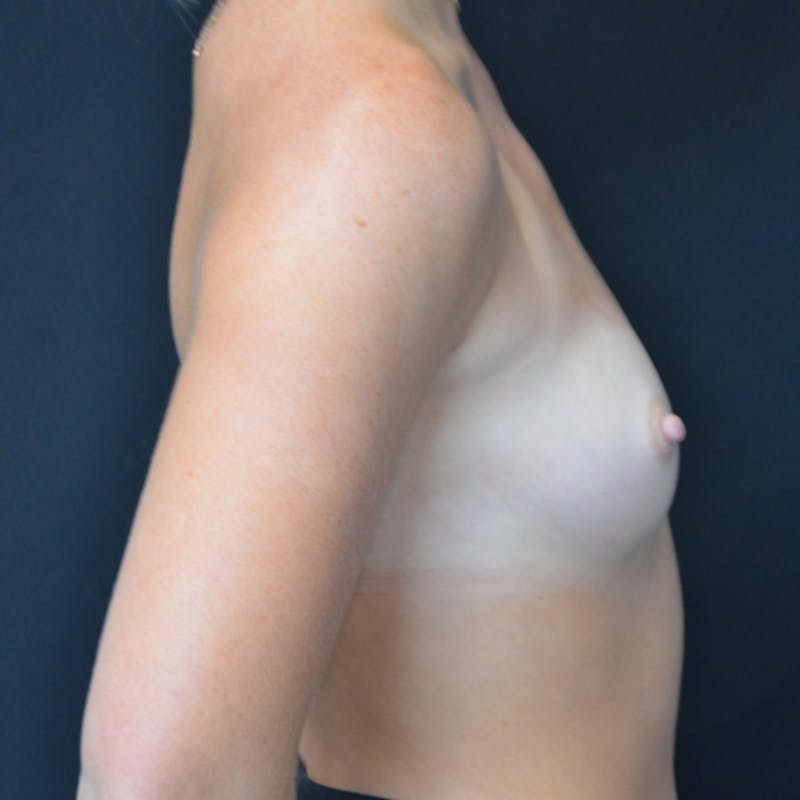 Breast Augmentation Before & After Gallery - Patient 114720976 - Image 7