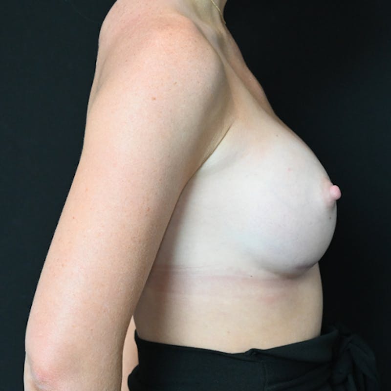 Breast Augmentation Before & After Gallery - Patient 114720976 - Image 8