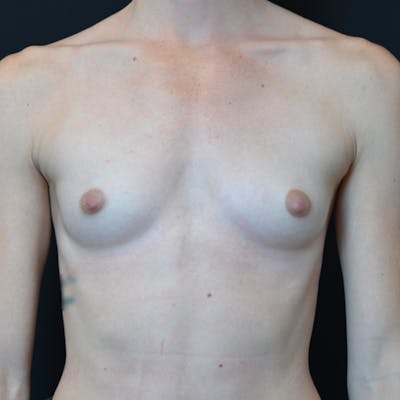 Breast Augmentation Before & After Gallery - Patient 114720983 - Image 1