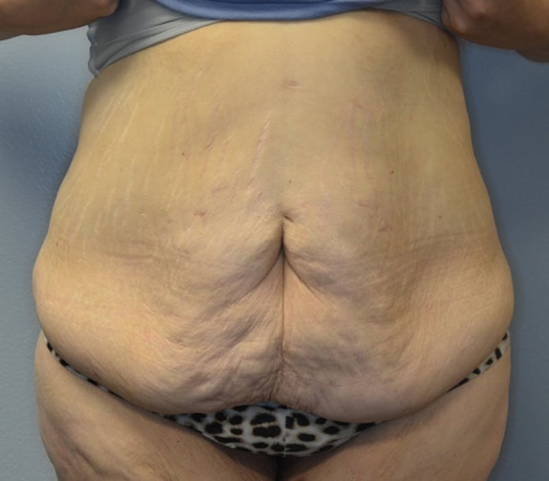 Abdominoplasty (Tummy Tuck) Before & After Gallery - Patient 114720984 - Image 1