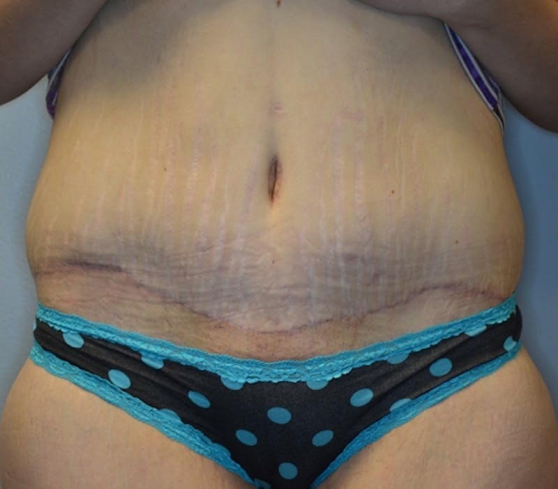 Abdominoplasty (Tummy Tuck) Before & After Gallery - Patient 114720984 - Image 2