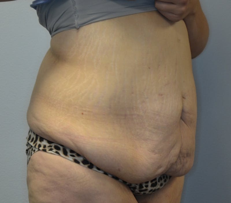 Abdominoplasty (Tummy Tuck) Before & After Gallery - Patient 114720984 - Image 3