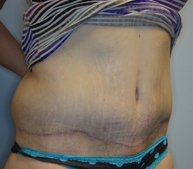 Abdominoplasty (Tummy Tuck) Before & After Gallery - Patient 114720984 - Image 4