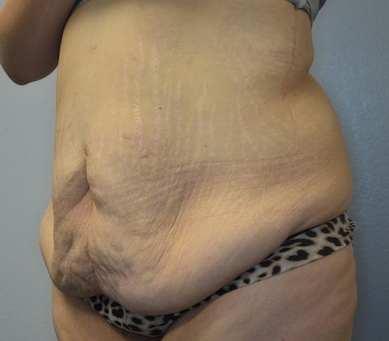 Abdominoplasty (Tummy Tuck) Before & After Gallery - Patient 114720984 - Image 5