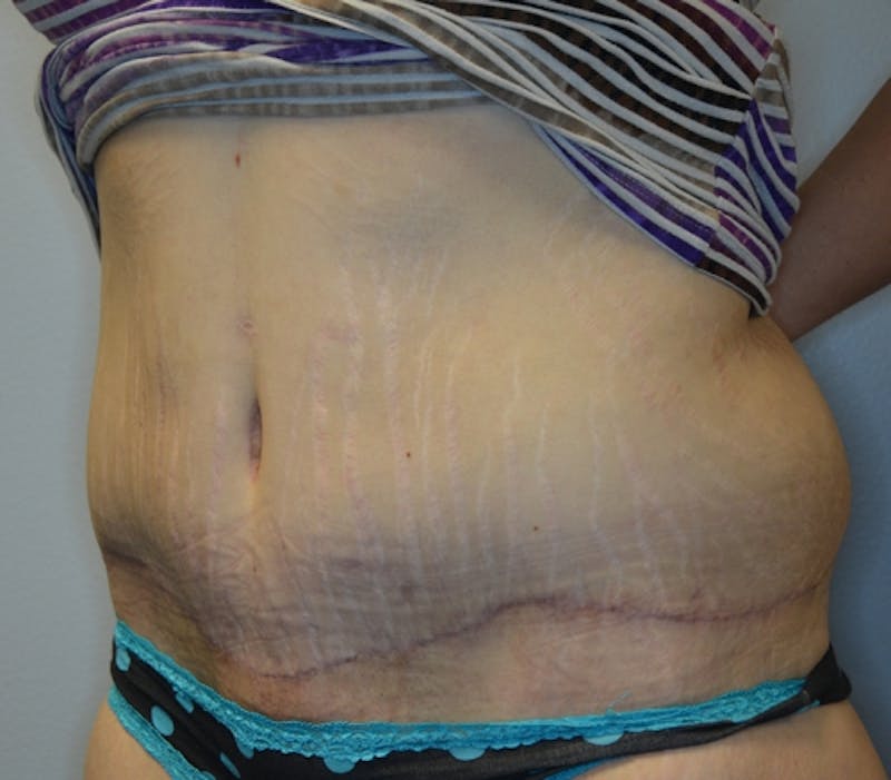 Abdominoplasty (Tummy Tuck) Before & After Gallery - Patient 114720984 - Image 6