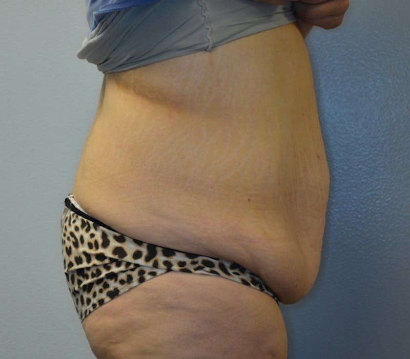 Abdominoplasty (Tummy Tuck) Before & After Gallery - Patient 114720984 - Image 7