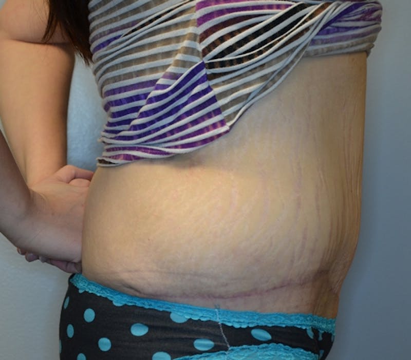 Abdominoplasty (Tummy Tuck) Before & After Gallery - Patient 114720984 - Image 8