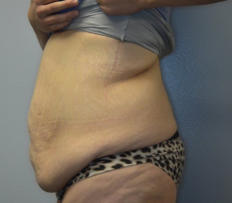 Abdominoplasty (Tummy Tuck) Before & After Gallery - Patient 114720984 - Image 9