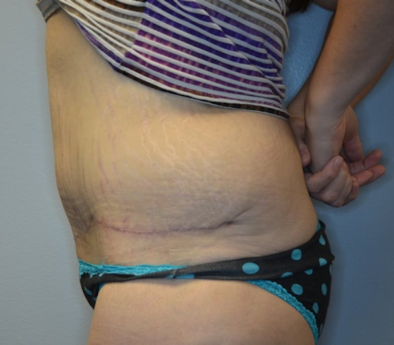 Abdominoplasty (Tummy Tuck) Before & After Gallery - Patient 114720984 - Image 10