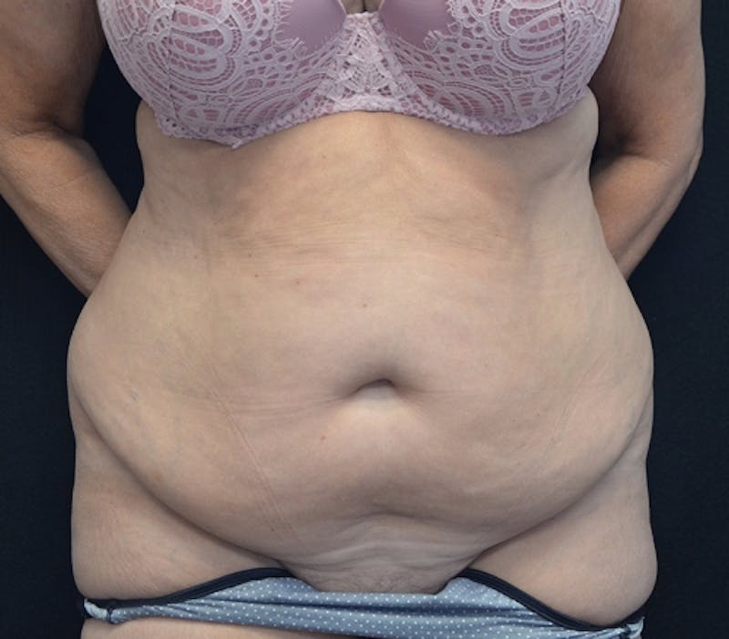 Abdominoplasty (Tummy Tuck) Before & After Gallery - Patient 114720989 - Image 1