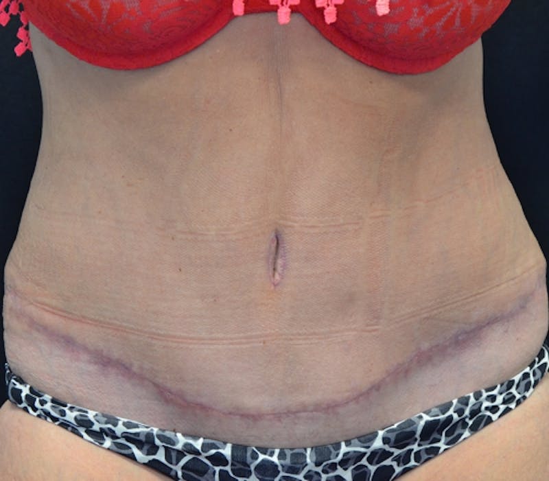 Abdominoplasty (Tummy Tuck) Before & After Gallery - Patient 114720989 - Image 2