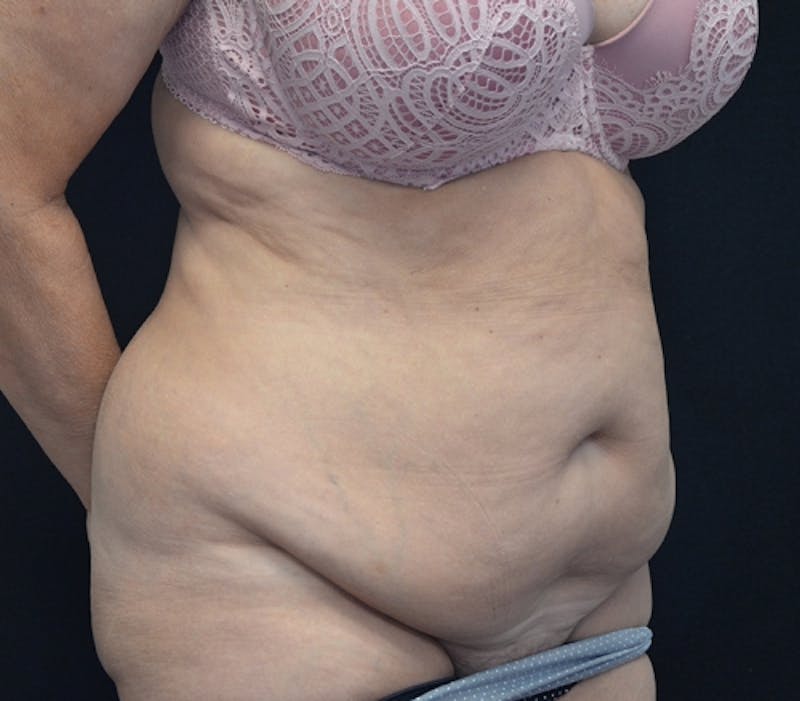 Abdominoplasty (Tummy Tuck) Before & After Gallery - Patient 114720989 - Image 3