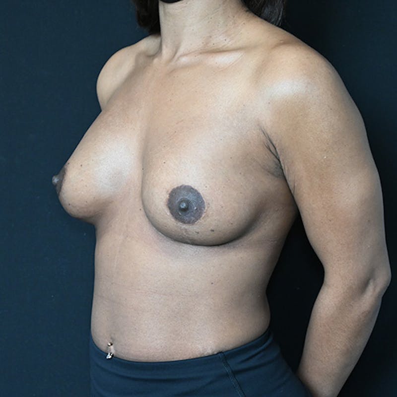 Breast Augmentation with Lift Before & After Gallery - Patient 114720986 - Image 6