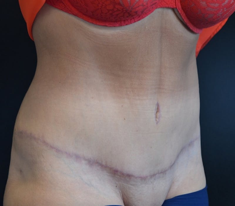 Abdominoplasty (Tummy Tuck) Before & After Gallery - Patient 114720989 - Image 4