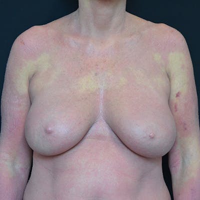Breast Lift Before & After Gallery - Patient 114720990 - Image 1
