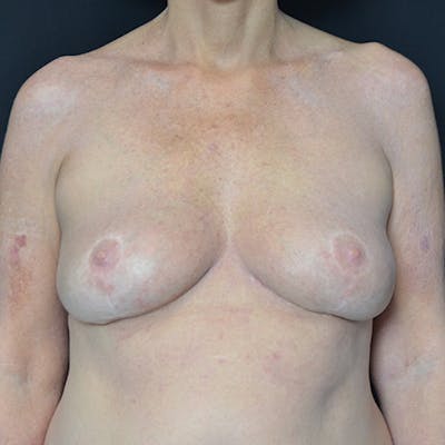 Breast Lift Before & After Gallery - Patient 114720990 - Image 2