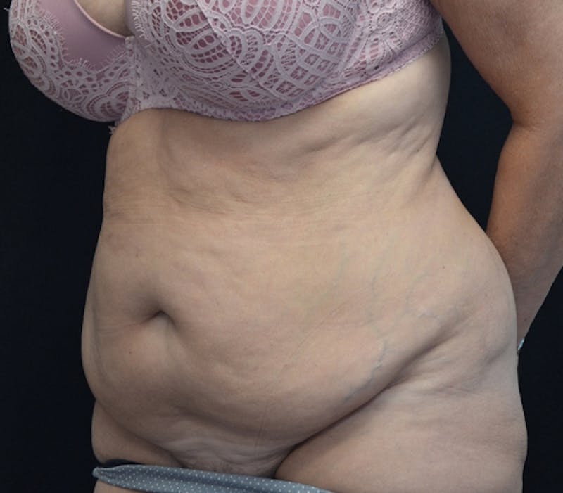 Abdominoplasty (Tummy Tuck) Before & After Gallery - Patient 114720989 - Image 5