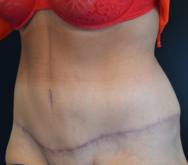 Abdominoplasty (Tummy Tuck) Before & After Gallery - Patient 114720989 - Image 6