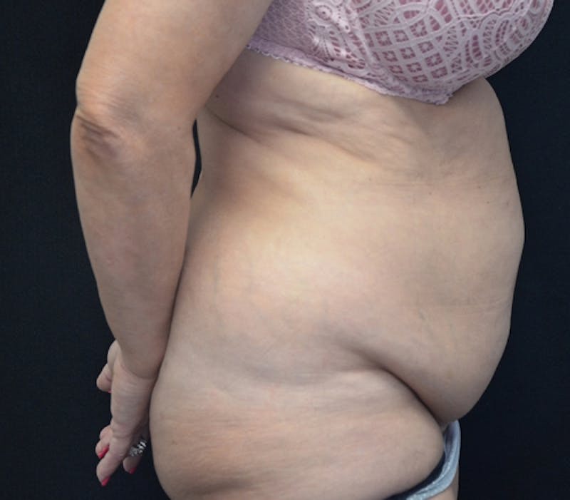Abdominoplasty (Tummy Tuck) Before & After Gallery - Patient 114720989 - Image 7