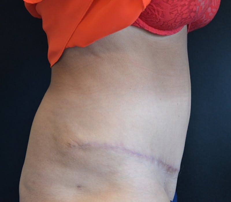 Abdominoplasty (Tummy Tuck) Before & After Gallery - Patient 114720989 - Image 8
